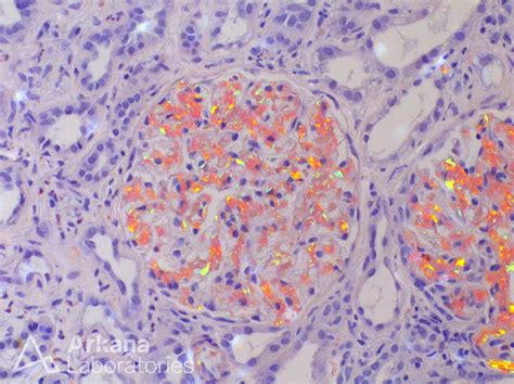 Renal Amyloidosis Congo Red / Amyloidosis Part 3 Morphology Diagnosis ...