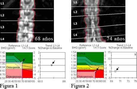 Prueba de densidad ósea: Resultado normal y osteoporosis ...