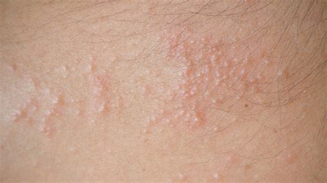 11 NATURAL WAYS TO GET RID OF HEAT RASHES - Health GadgetsNG