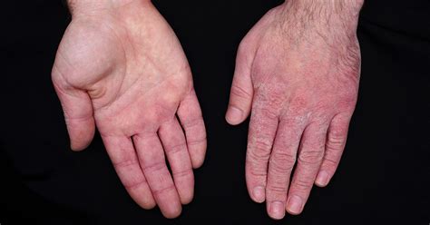 5 ways to treat your chapped hands | Nebraska Medicine Omaha, NE