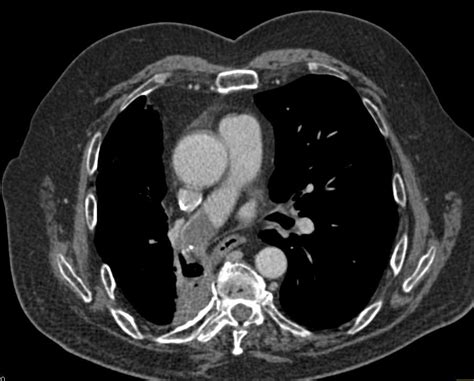 Large Right Pulmonary Embolism - Chest Case Studies - CTisus CT Scanning