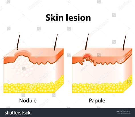 Papule Nodule Skin Lesion Stock Illustration 386528674 | Shutterstock