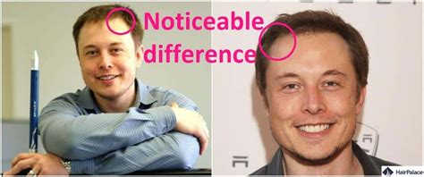 Elon Musk Hair Transplant | The Secret of His Amazing Result