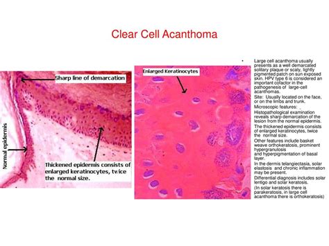 Clear cell acanthoma or Degos' acanthoma - ppt download