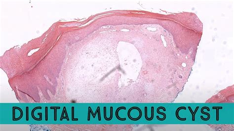 Digital mucous cyst (Digital myxoid cyst) similar to ganglion cyst (pathology dermpath ...