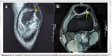 Figure 1 from Bipartite Patella in an Elite Football Player – A Rare Cause of Anterior Knee Pain ...