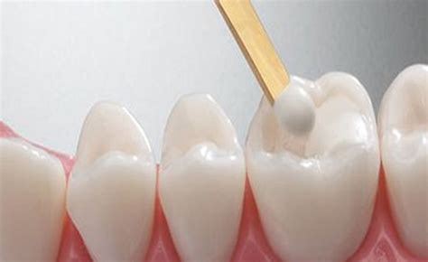 Advantages of White Dental Fillings - Top Rated Cosmetic & General ...