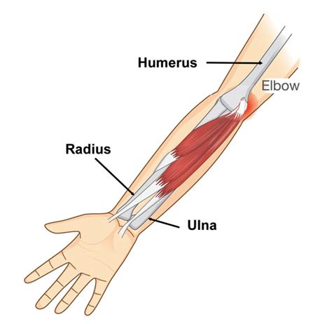 Elbow Avulsion Fracture - Symptoms, Causes, Treatment & Rehabilitation