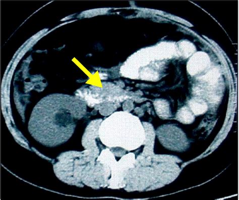 Contrast enhanced computerized tomography of the abdomen, showing a ...