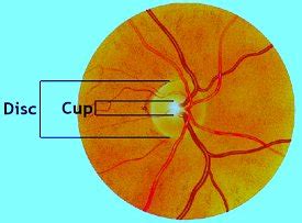 Cup to Disc Ratio | Waverley Eye Care Centre