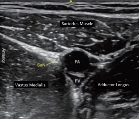 Evaluation of Analgesic Efficacy of Ultrasound-Guided Adductor Canal Block With 20 mL of 0.5% ...