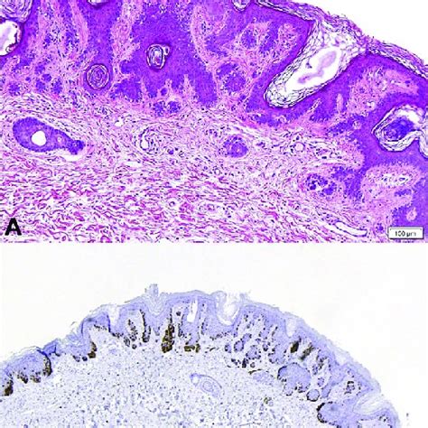 High-grade atypical nevus with SK changes on histopathologic ...