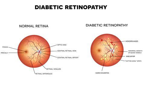 Diabetic Retinopathy – Dr. Winston J. Scott