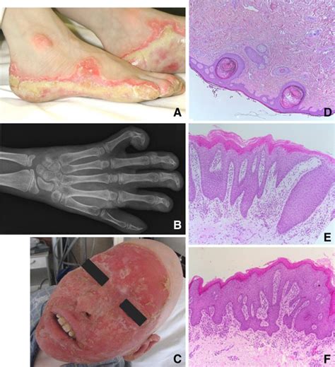 Olmsted syndrome: exploration of the immunological phenotype | Orphanet Journal of Rare Diseases ...