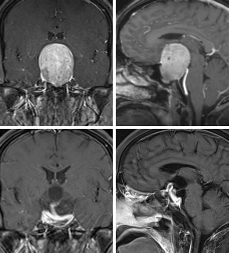 Craniopharyngioma And Pituitary Adenoma