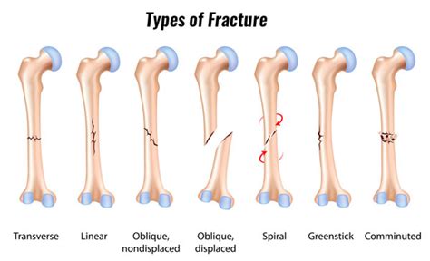 Tibia Fracture - Symptoms, Causes, Treatment & Rehabilitation