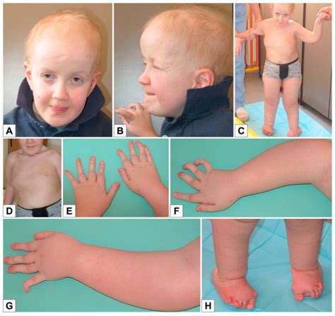 Genes | Free Full-Text | Severe Peripheral Joint Laxity is a Distinctive Clinical Feature of ...