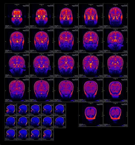 Functional magnetic resonance imaging - NeuRA Library