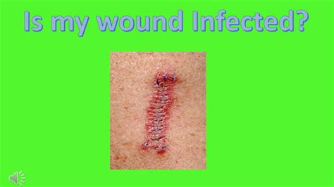 Infected Wound Spell World Of Warcraft