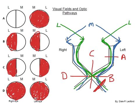 optic chiasm injury - Google Search | Biology, Anatomy, Science biology