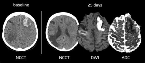 MR-DWI in the acute stroke diagnosis | STROKE MANUAL