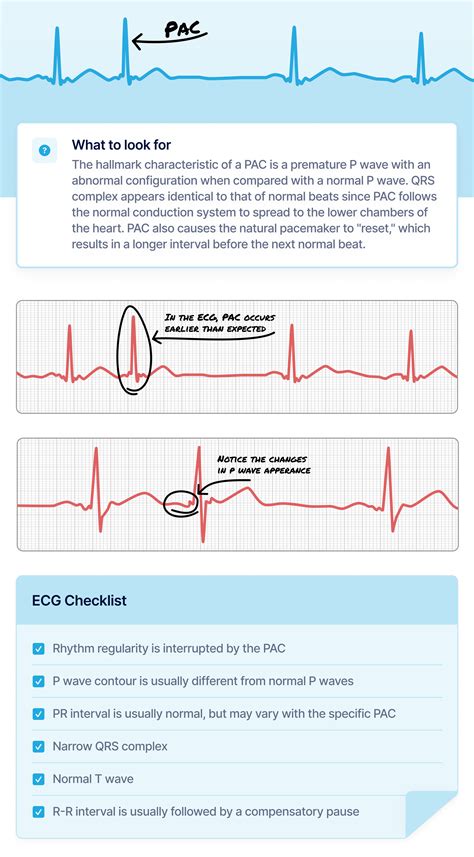 Premature Atrial Contractions