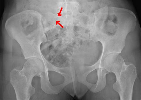 Image Gallery sacrum fracture