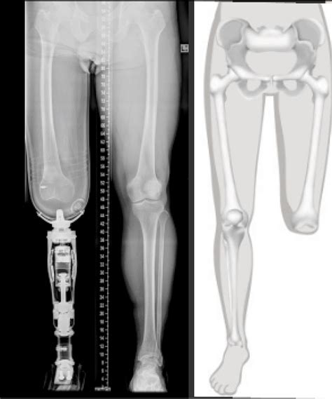 Through knee Prosthetics – Northcliff Orthopaedic Centre