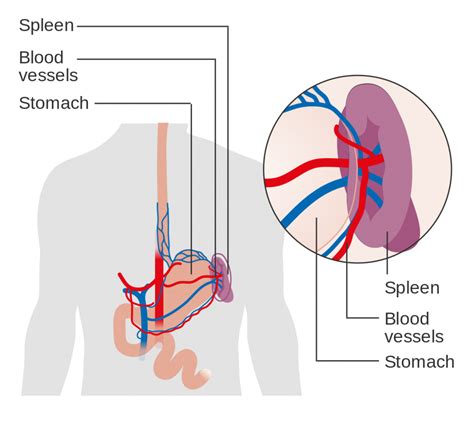 Laparoscopic Splenectomy Surgery, Treatment & Cost Texas USA