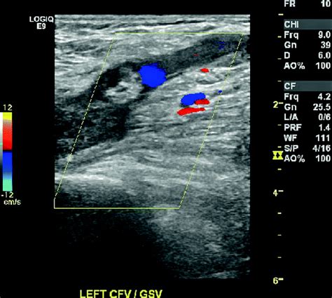 Venous Duplex Ultrasound of the Lower Extremity in the Diagnosis of ...