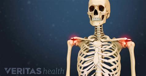 Acromioclavicular (AC) Joint Osteoarthritis Video