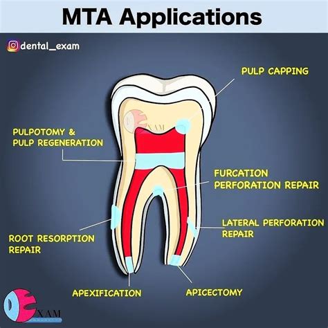 Mineral Trioxide Aggregate It was developed for use as a dental root repair material by Mahmoud ...