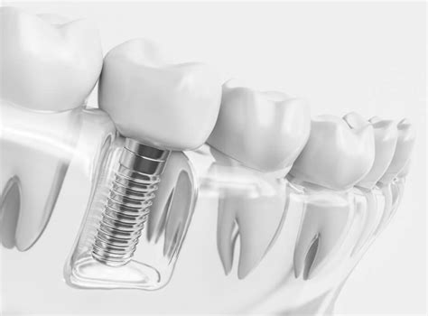 The Pros And Cons Of Dental Implants & Dental Crowns