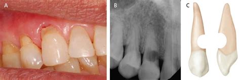 External Root Resorption | Atlas Dental, Toronto Dentist