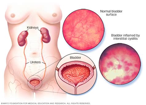 Interstitial cystitis Disease Reference Guide - Drugs.com