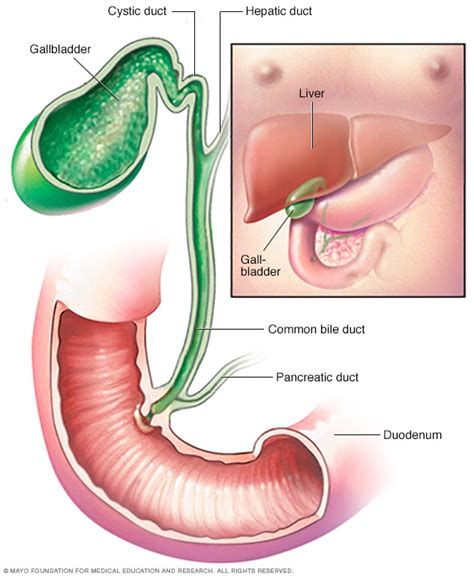 Cholecystitis - Symptoms and causes - Mayo Clinic