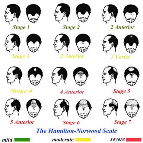 Best Hair Loss Solution: About The Hamilton-Norwood Scale