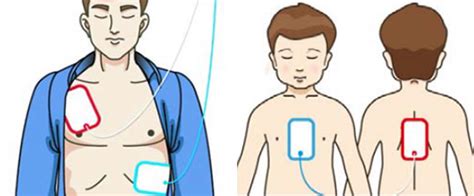 How does an automated external defibrillator work? - Mindray