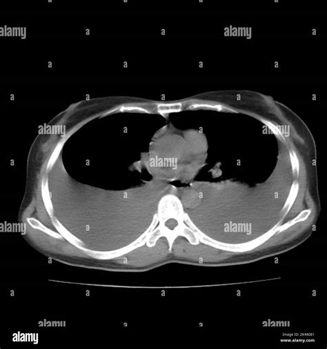 Pleural effusion, CT scan Stock Photo - Alamy