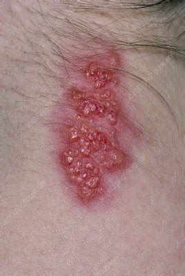 Close-up of shingles rash on back of woman's neck - Stock Image - M260/0138 - Science Photo Library