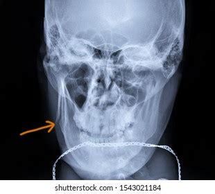 Mandibular Fracture X Ray