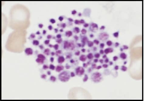 Physiological and pathological platelet morphology. (A) Normal ...