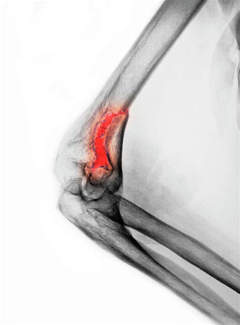 Elbow Fracture Photograph by Mauro Fermariello/science Photo Library