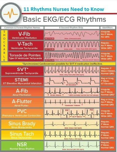 EKG Rhythms | Nurse, Nursing school studying, Nursing mnemonics