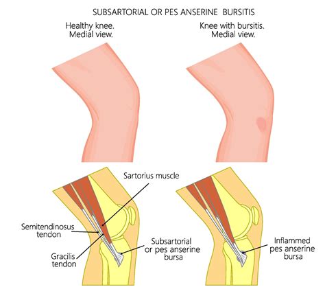 Pes Anserine bursitis, Pes anserine syndrome, lower hamstring tendonitis