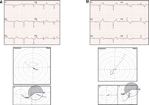 (A) Upper panel: ECG – anterior Q wave MI (with positive T-waves ...