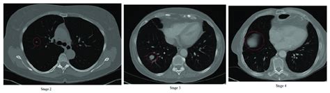 Stage 2 Of Lung Cancer