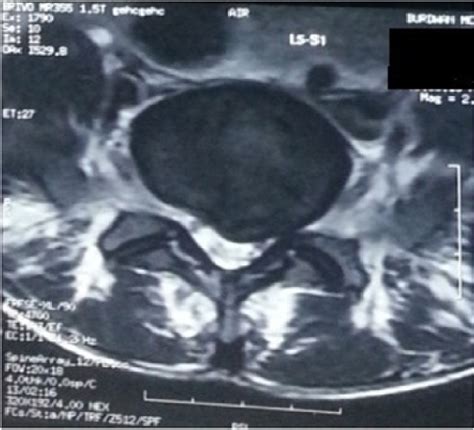 Paracentral Disc Herniation