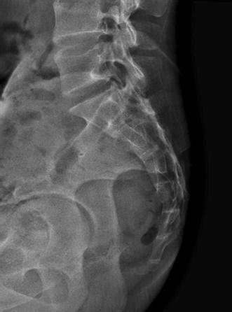 Lateral radiograph of the sacrum with coccyx showing a normal bony... | Download Scientific Diagram