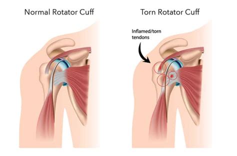 Rotator Cuff Tear | Symptoms, Repair, & Recovery Time